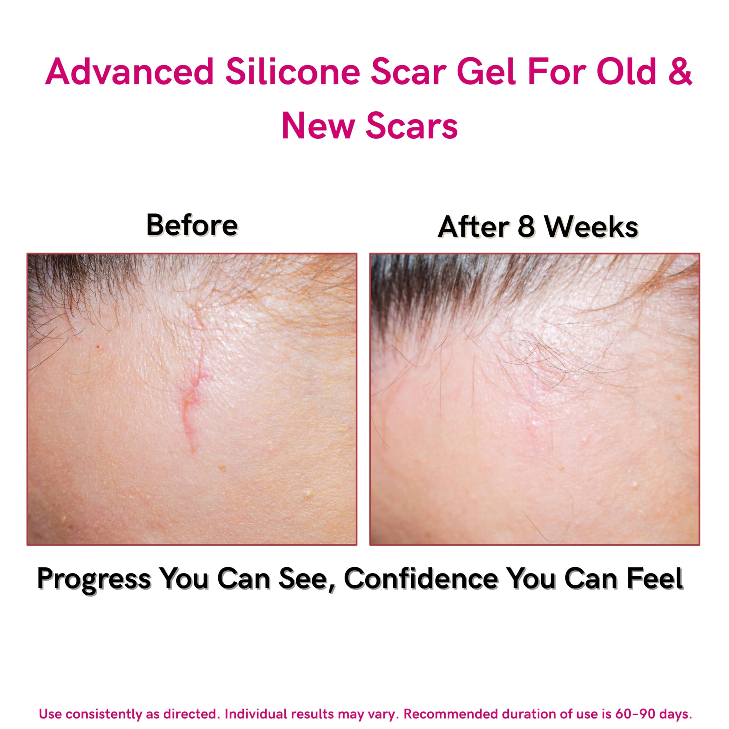 Lipoelastic gel silicone cicatrici vitamina E 10g trasparente